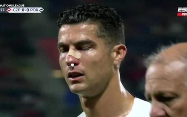 Rəqib qapıçı Ronaldonun burnunu əzdi - Şəkillər